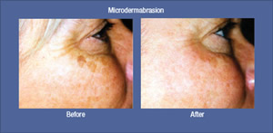 Microdermabrasion Before and After