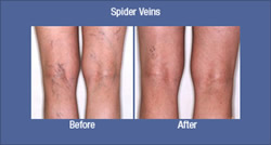 Spider Vein Injection Before and After